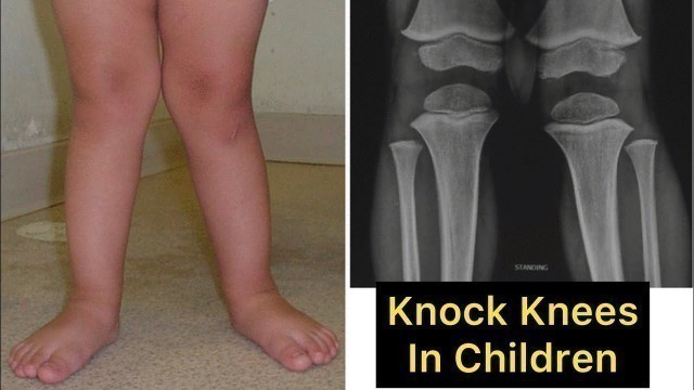 'Knock Knees in Children: Correction Exercises'