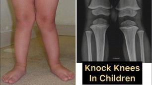 'Knock Knees in Children: Correction Exercises'