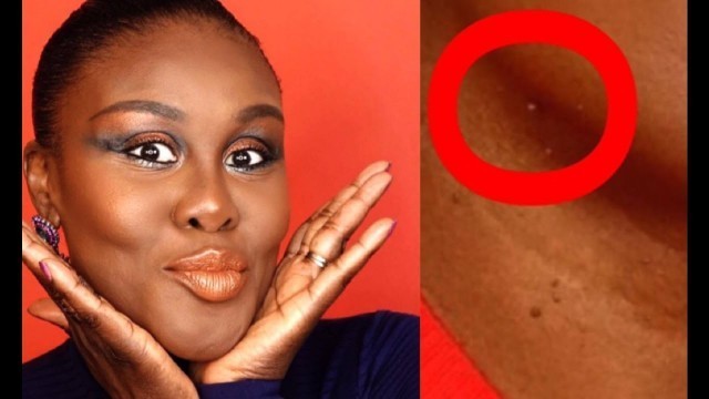 'How To Get Rid of Skin Tags - Easy DIY at Home :) Beauty Hacks - Fumi Desalu-Vold'