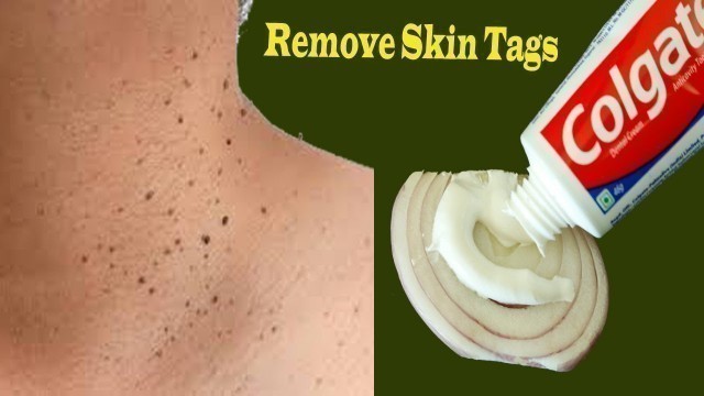 'Toothpaste Onion Beauty Hacks for Remove Skin Tags overnight | tips and tricks for Remove Skin Tags'
