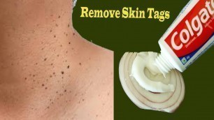 'Toothpaste Onion Beauty Hacks for Remove Skin Tags overnight | tips and tricks for Remove Skin Tags'