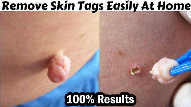 'Proven Ways to Remove Skin Tags Naturally | Aisha Health With Beauty'