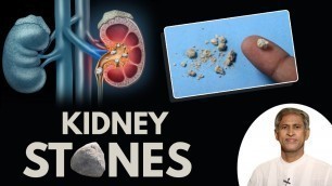 'What To Eat For Kidney Stone | Foods For Kidney Stones | Manthena Satyanarayana Raju Videos'