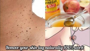 'remove skin tags/ home remedy to remove skin tags/ papilloma / beauty tips and trick'