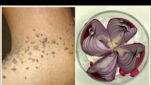 'REMOVE SKIN TAGS, MOLES AND WARTS, EFFECTIVE SKIN TAGS REMEDY,  |Khichi Beauty'