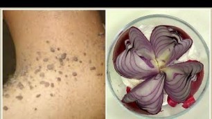 'REMOVE SKIN TAGS, MOLES AND WARTS, EFFECTIVE SKIN TAGS REMEDY,  |Khichi Beauty'