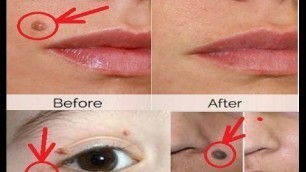 'Best Skin Tag Removal Methods - Skin tags removed easily - Beauty salon'