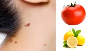'How  To  Remove  Skin  Tags With  Tomato /  Precious Beauty'