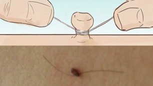 'How To Remove Warts Skin Tags And Naturally | Tamil Beauty Tips'