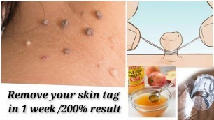 'Remove skin tags | home remedy to remove skin tags | papilloma |beauty tips'